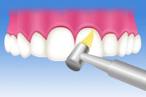 2.歯と歯の隙間清掃